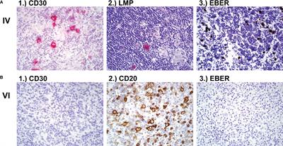 Immunodeficiency with susceptibility to lymphoma with complex genotype affecting energy metabolism (FBP1, ACAD9) and vesicle trafficking (RAB27A)